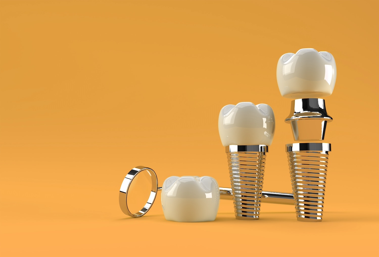 implantes dentales